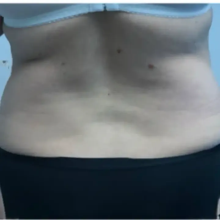 Before 360 liposuction