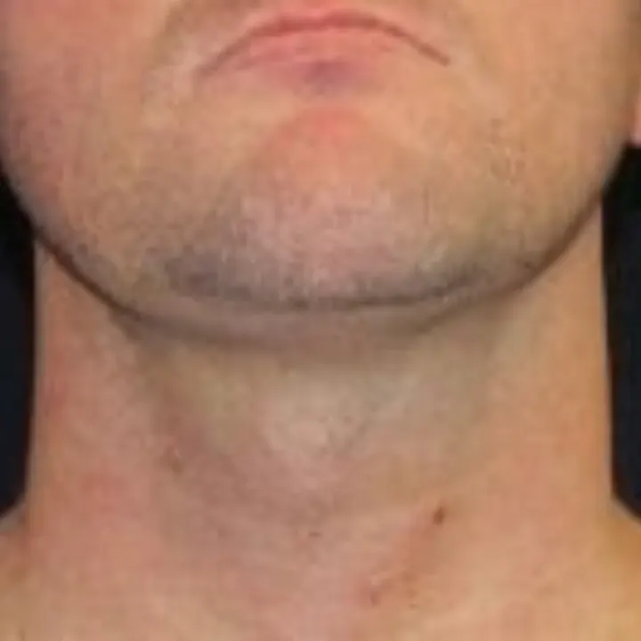 After chin liposuction