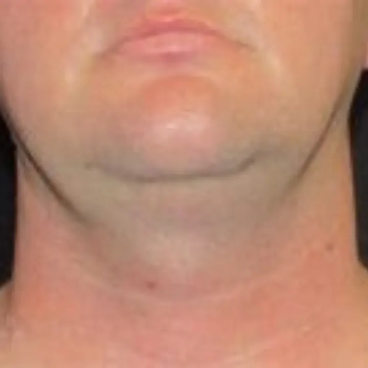 Before chin liposuction